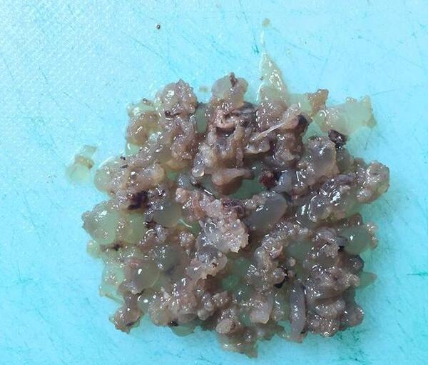 عکس بچه خوره در رحم