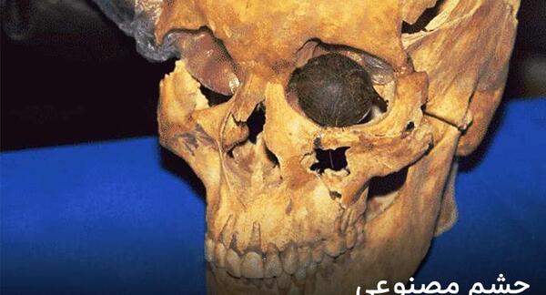 عکس چشم مصنوعی در شهر سوخته
