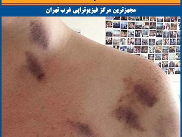 عکس شانه کبود