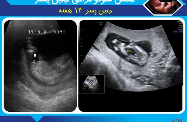 عکس جنین پسر یازده هفته
