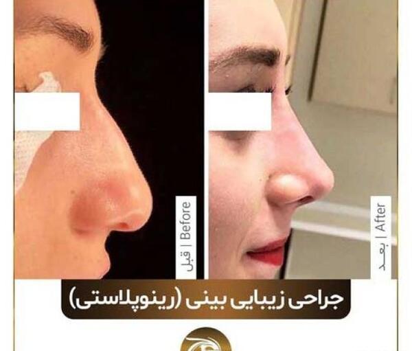 عکس پاسپورت بعد از عمل بینی