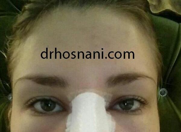 عکس کبودی بعد از عمل