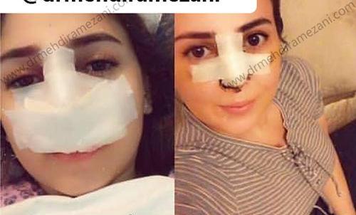 عکس کبودی بعد از عمل
