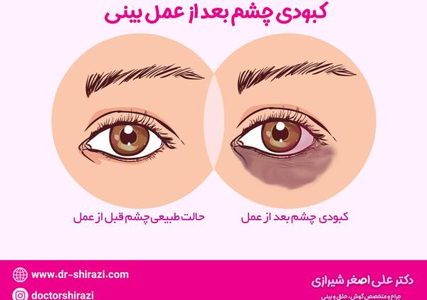 عکس کبودی بعد از عمل