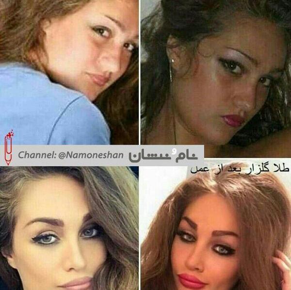 عکس گلزار قبل و بعد عمل بینی