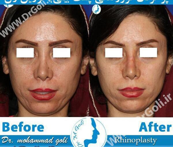 عکس قبل و بعد تزریق ژل بینی
