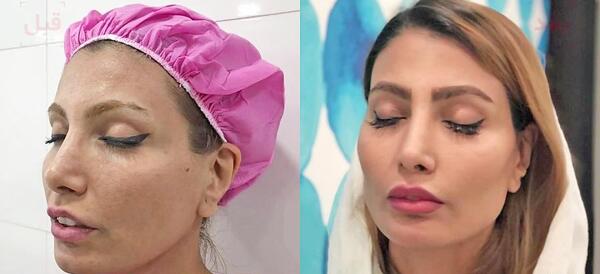 عکس قبل و بعد تزریق ژل بینی