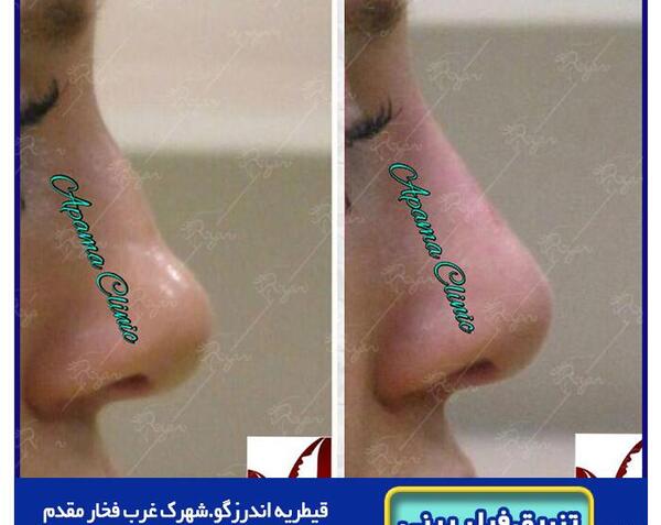 عکس قبل و بعد تزریق ژل بینی