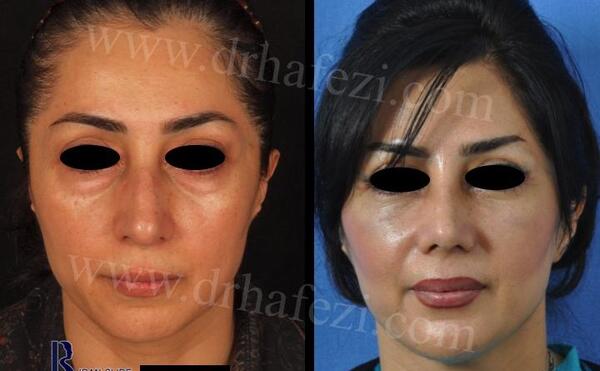 عکس قبل و بعد تزریق ژل بینی