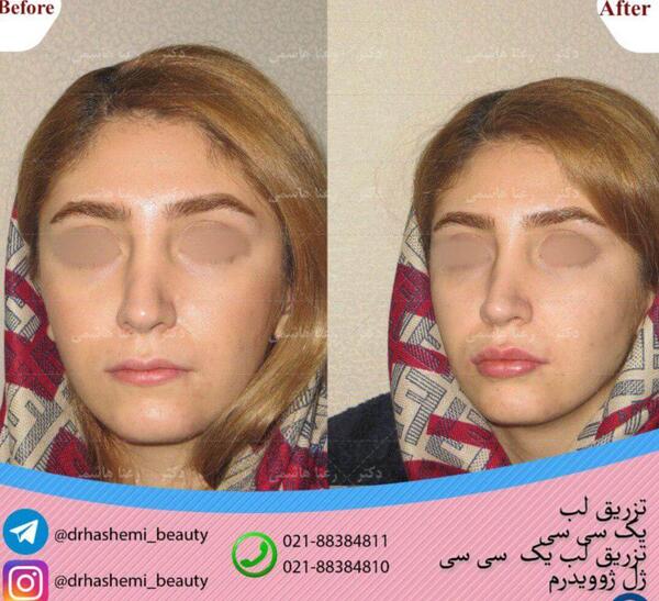 عکس قبل و بعد تزریق ژل بینی