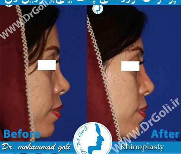 عکس قبل و بعد تزریق ژل بینی
