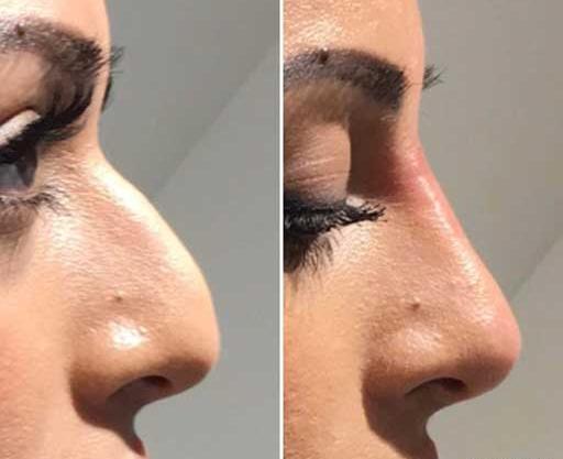 عکس قبل و بعد تزریق ژل بینی