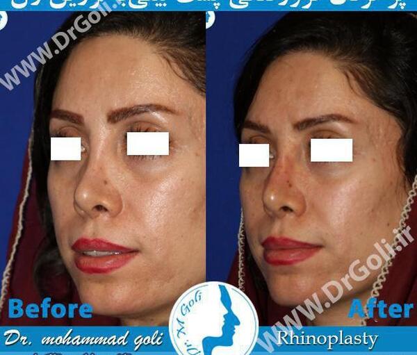 عکس قبل و بعد تزریق ژل بینی