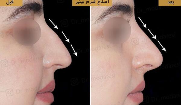 عکس قبل و بعد تزریق ژل بینی