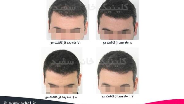 عکس یک ماه بعد از کاشت مو