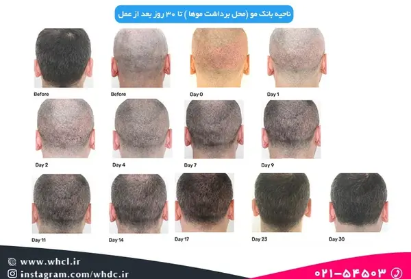عکس یک ماه بعد از کاشت مو