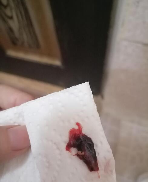 عکس بچه سقط شده