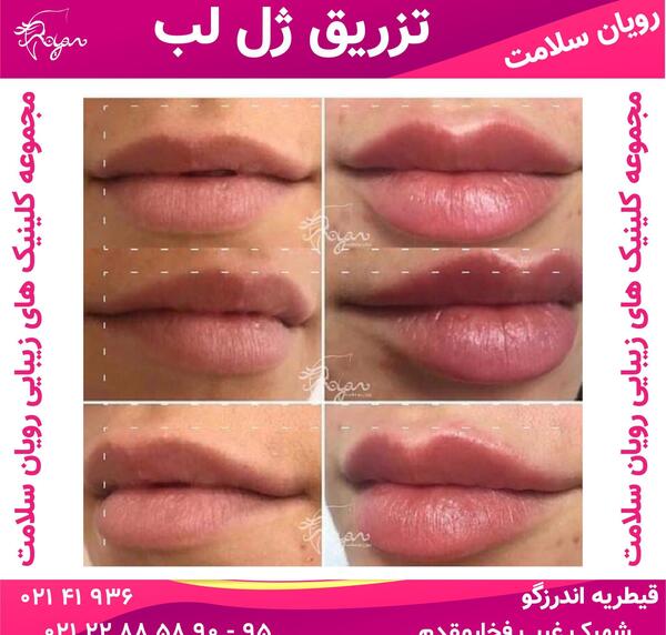 عکس لب قبل و بعد از پروتز