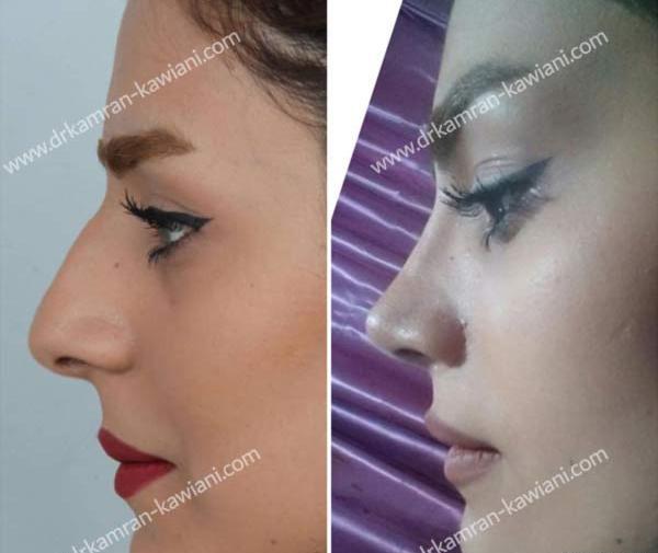 عکس دختر زیبا دماغ عملی