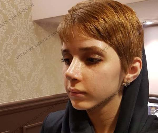 عکس دختر زیبا دماغ عملی