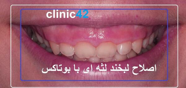 عکس بوتاکس لبخند لثه ای