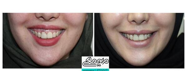 عکس بوتاکس لبخند لثه ای