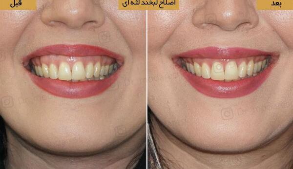 عکس بوتاکس لبخند لثه ای