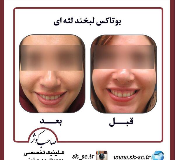 عکس بوتاکس لبخند لثه ای