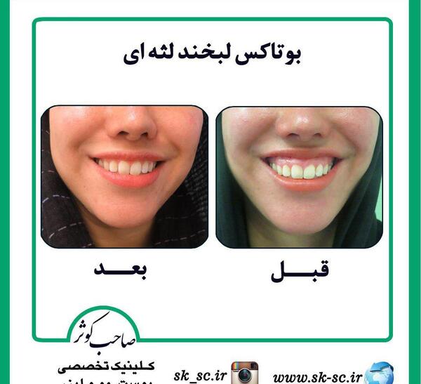 عکس بوتاکس لبخند لثه ای