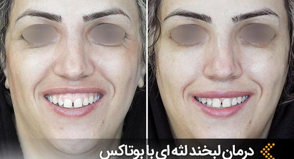 عکس بوتاکس لبخند لثه ای