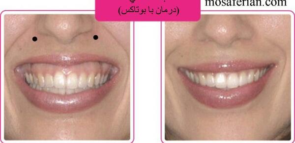 عکس بوتاکس لبخند لثه ای