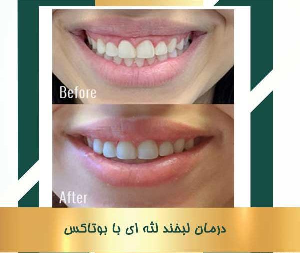 عکس بوتاکس لبخند لثه ای