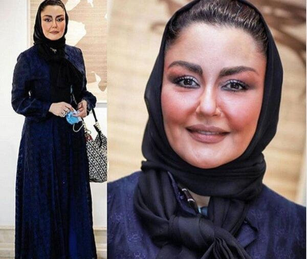 عکس شقایق دهقان بعد از عمل بینی