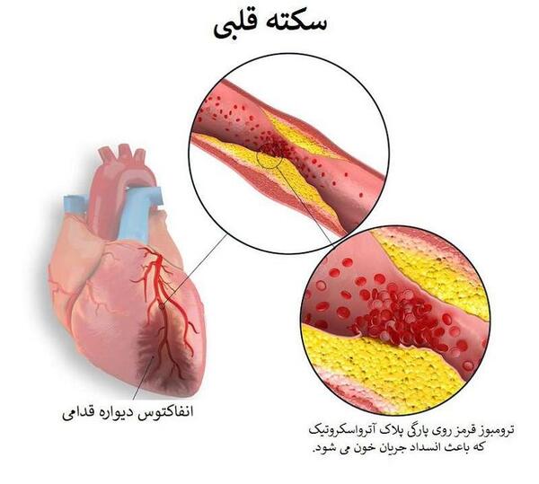 عکس قلب چربی گرفته