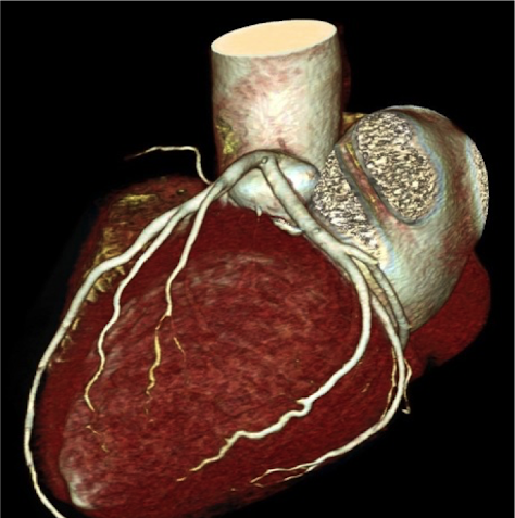 عکس قلب چربی گرفته