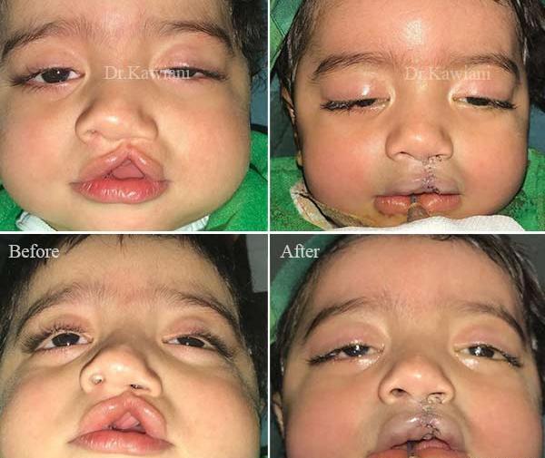 عکس نوزاد لب شکری