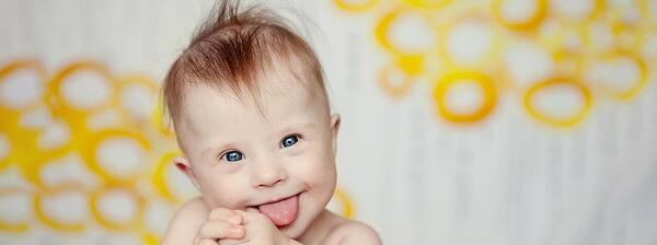 عکس نوزاد سندروم داون