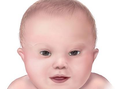عکس نوزاد سندروم داون
