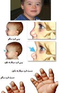 عکس نوزاد سندروم داون