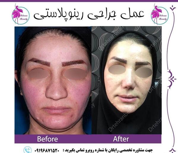 عکس سه بعدی عمل بینی