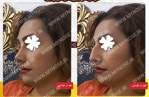 عکس سه بعدی عمل بینی