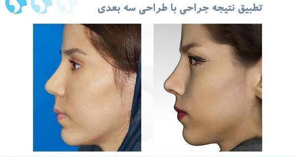 عکس سه بعدی عمل بینی