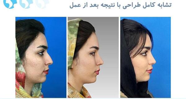 عکس سه بعدی عمل بینی