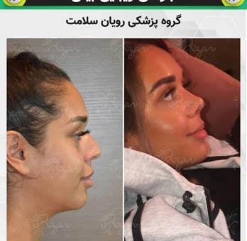 عکس سه بعدی عمل بینی
