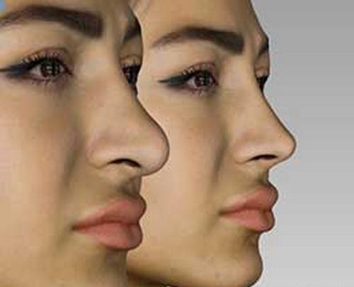 عکس سه بعدی عمل بینی