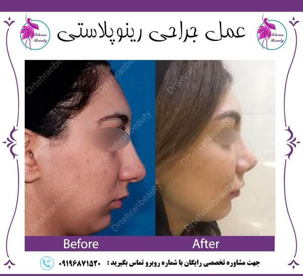 عکس سه بعدی عمل بینی