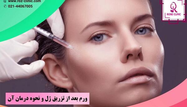 عکس کبودی بعد از تزریق چربی