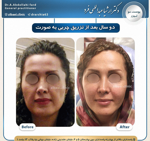 عکس کبودی بعد از تزریق چربی