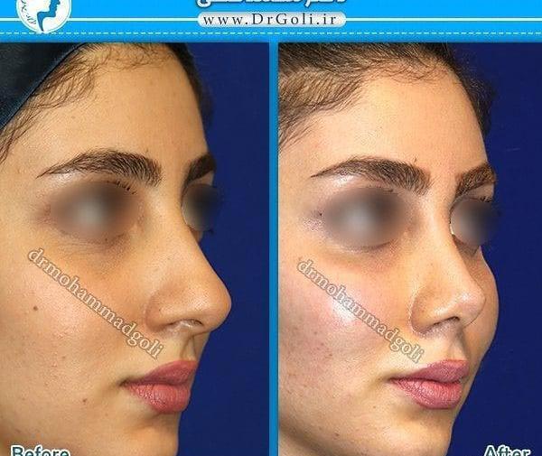 عکس کبودی بعد از تزریق چربی