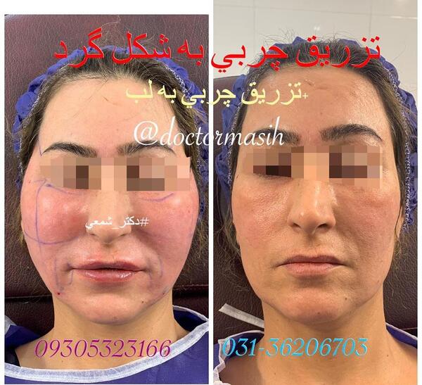 عکس کبودی بعد از تزریق چربی